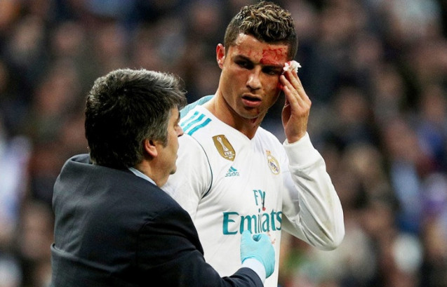 Криштиану Роналду во время футбольного матча разбили лицо.
